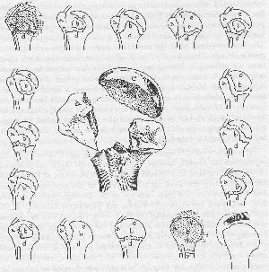 Shoulder:Trauma - WikiBeemed