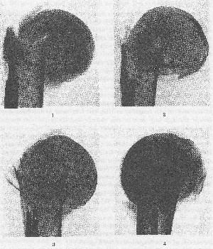 Shoulder:Trauma - WikiBeemed