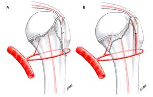 Figure 4 role de l'extension métaphjysaire.jpg