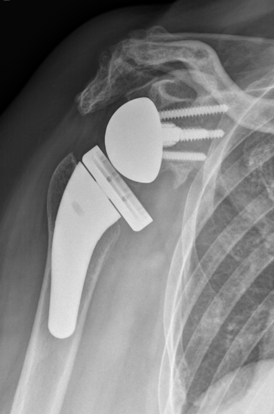 File:Acromial fracture.png