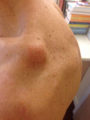 Figure. 10 Acromioclavicular dislocation