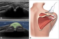 Acromioclavicular joint and visualization of “bulging” of the acromioclavicular ligament signifying presence of an effusion. Ultrasound image (a) with superimposed anatomy (b) and patient/probe position (c). Reproduce from Plomb-Holmes et al., with permission.
