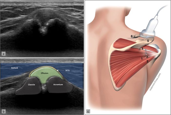 Figure. 4 Acromioclavicular joint and visualization of “bulging” of the acromioclavicular ligament signifying presence of an effusion. Ultrasound image (a) with superimposed anatomy (b) and patient/probe position (c). Reproduce from Plomb-Holmes et al., with permission.