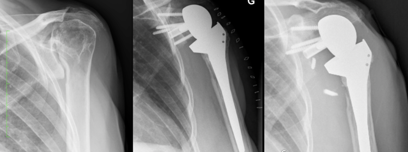 File:Scapular notching.png