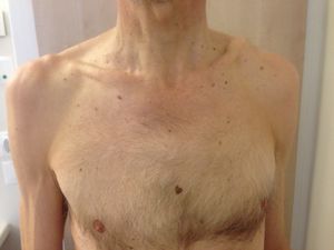 Figure. 10 Acromioclavicular dislocation